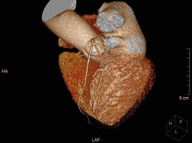 Приказ на коронарни артерии со неивазивна КТ коронарографија